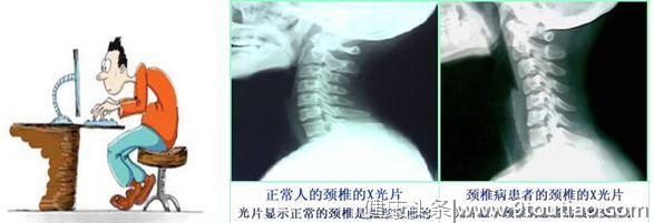 49岁小学老师得了颈椎病，这个理由，医生建议她必须手术治疗！