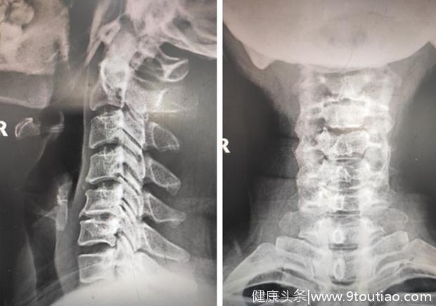 49岁小学老师得了颈椎病，这个理由，医生建议她必须手术治疗！