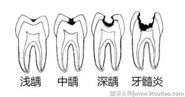 “牙疼不是病，疼起来要人命”，口腔专家教你预防蛀牙