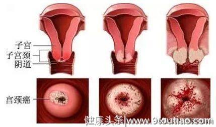 母亲宫颈癌子宫全切、女儿宫颈病变2级，宫颈癌难道遗传吗？