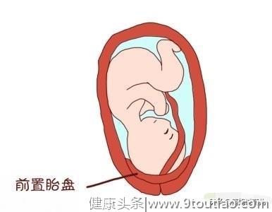 胎盘位于子宫前壁与前置胎盘的区别是什么？