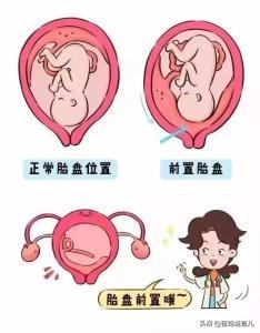 胎盘位于子宫前壁与前置胎盘的区别是什么？