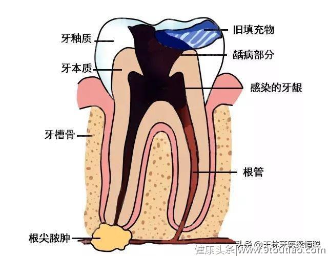 牙齿发炎常规处理？当心延误病情！ （值得收藏，推荐）