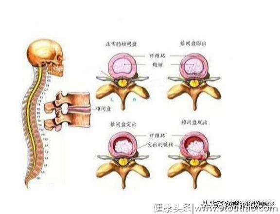 腰椎间盘还在疼痛？并不一定是椎间盘突出，骨科大夫有3说