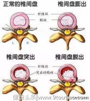 腰椎间盘还在疼痛？并不一定是椎间盘突出，骨科大夫有3说