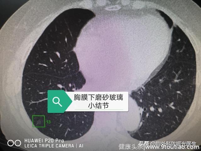 医生，这肺结节除了会是肺癌，还可能是什么?