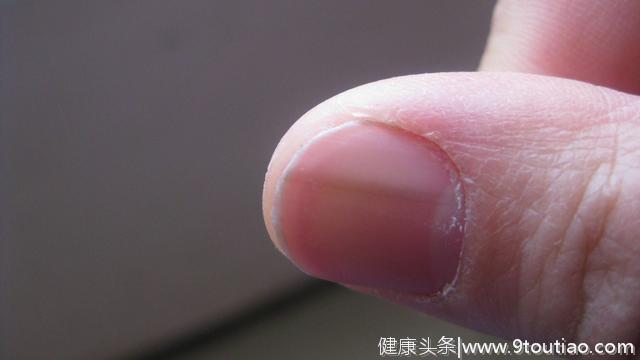 指甲上出现很多竖纹，就是大病的征兆吗？看看养生专家怎么说