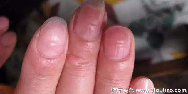 指甲上出现很多竖纹，就是大病的征兆吗？看看养生专家怎么说