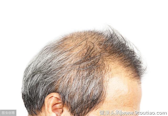 脱发朋友的终极困扰：有什么好办法治疗脱发吗？
