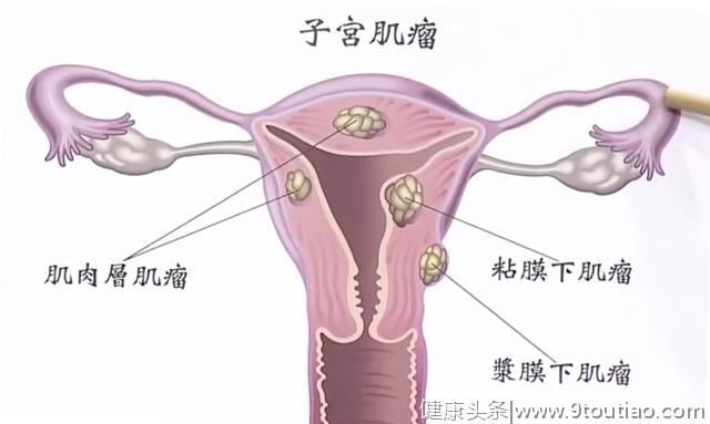 子宫肌瘤恐导致不孕，一定要切除吗？看完这5个问题你就知道了