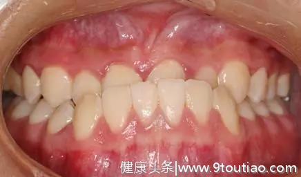 牙齿不齐不是小事，会影响你一生的颜值-济宁丁香树口腔医院