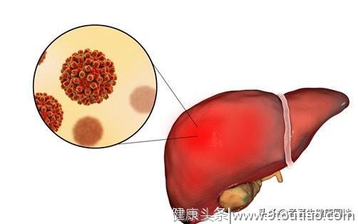 中年男子，从不喝酒却查出肝癌，2件事做的太多，肝同样承受不起