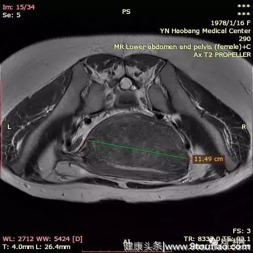 微·无创 | NO.17 病例分享 之 子宫腺肌症Gn-Rha结合微波治疗