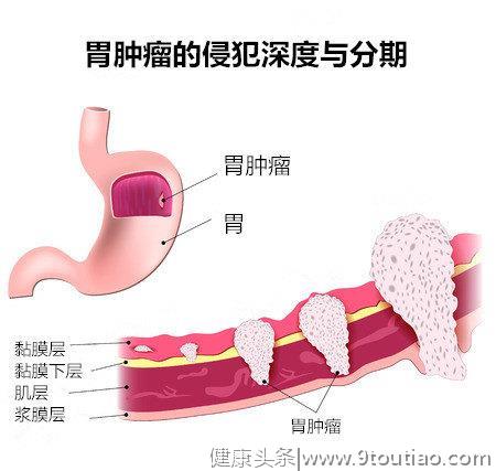 胃癌手术，微创和“开大刀”有何不同？这几种胃癌适合“开大刀”