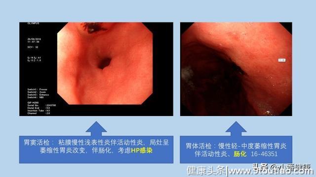 幽门螺杆菌致胃癌 消瘦恶心上腹部饱胀 除胃镜还需筛查HP