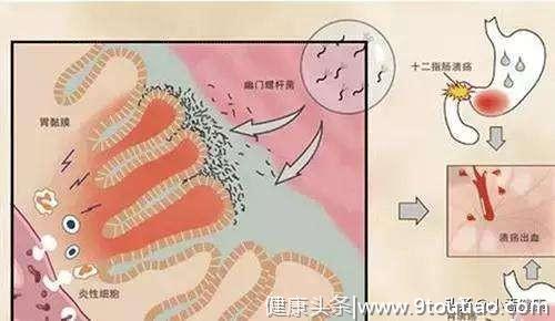 幽门螺杆菌致胃癌 消瘦恶心上腹部饱胀 除胃镜还需筛查HP