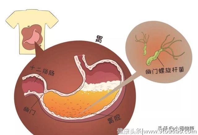 幽门螺杆菌致胃癌 消瘦恶心上腹部饱胀 除胃镜还需筛查HP