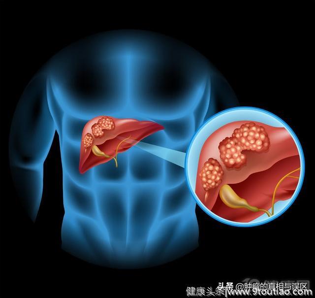 得了肝癌，为什么肝功能正常？原因其实很简单
