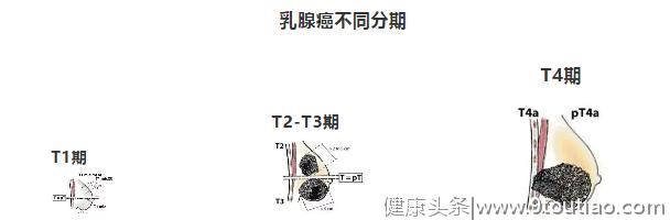 乳腺癌病理报告，不用看懂全部，知道这4个重要指标就够了