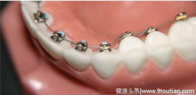 牙齿矫正价差好大？牙科诊所：材质、设计不同，价格也会有所差异