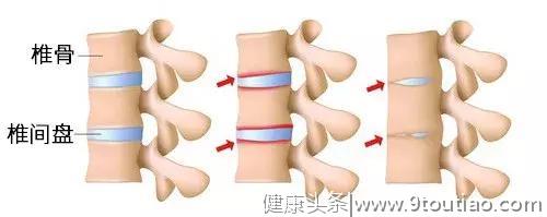 脖子痛、腰痛？专家教你自测脊柱衰老程度