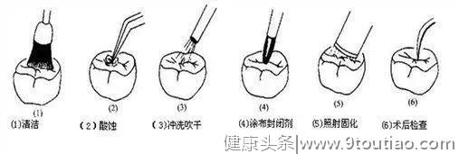 90% 儿童蛀牙可预防？儿科医生强烈推荐这 4 种办法