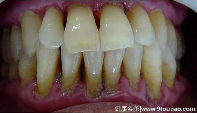 牙龈里面的牙结石，怎么清除干净？2个小方法告别牙周炎