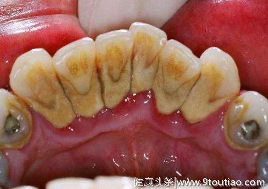 牙龈里面的牙结石，怎么清除干净？2个小方法告别牙周炎