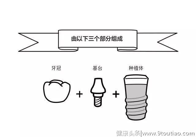 聪明人不会错过的种植体挑选秘籍