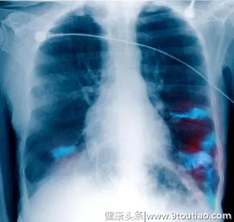 “肺癌”七成是晚期？身体5处“警报”，肺癌细胞已慢性“扩散”