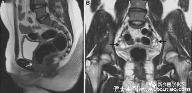 子宫发育异常，应想到的6大类常见畸形