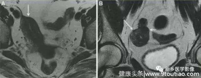 子宫发育异常，应想到的6大类常见畸形