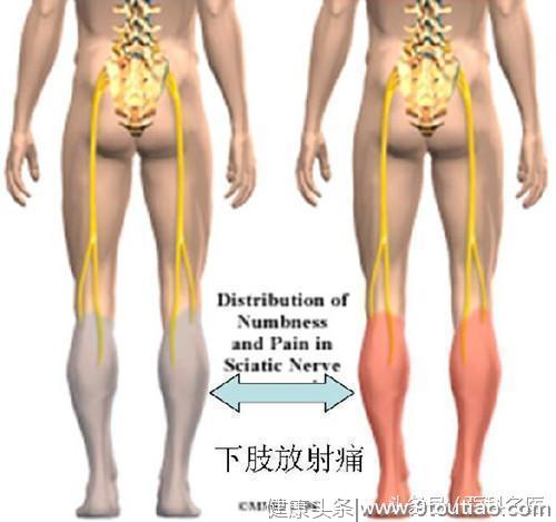 怎么判断自己是不是腰间盘突出？