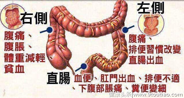 肠癌发生时往往是晚期？当大便有这些情况时，可能是肠癌早期信号