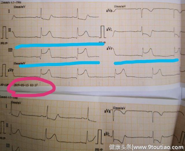 辟谣：心电图＋心肌酶正常，排除冠心病？医生：不能忽视症状   