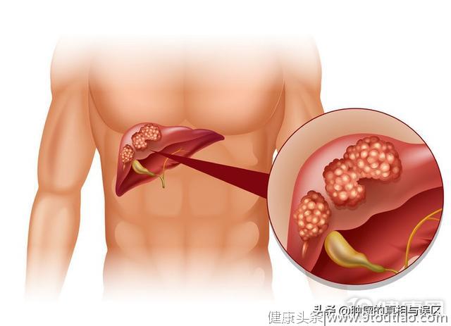 乙肝离肝癌有多远？3个症状是癌变“苗头”