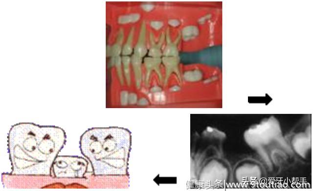 儿童牙齿交替很重要 及时发现早处理 空间维持器来帮你