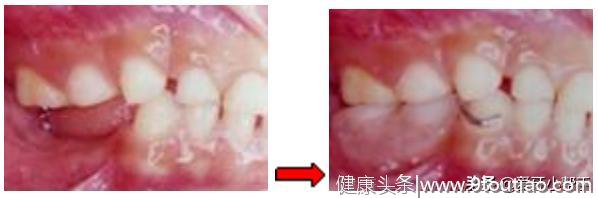 儿童牙齿交替很重要 及时发现早处理 空间维持器来帮你