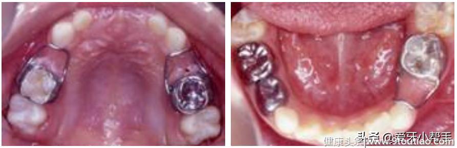 儿童牙齿交替很重要 及时发现早处理 空间维持器来帮你
