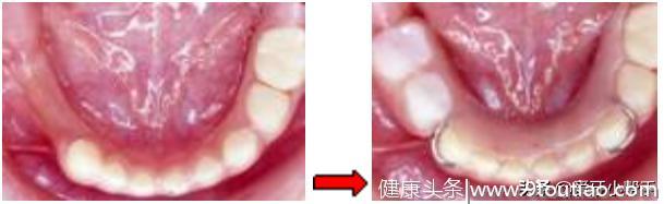 儿童牙齿交替很重要 及时发现早处理 空间维持器来帮你