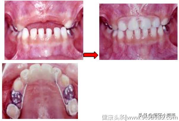 儿童牙齿交替很重要 及时发现早处理 空间维持器来帮你