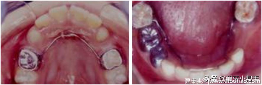 儿童牙齿交替很重要 及时发现早处理 空间维持器来帮你