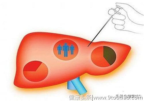 体检发现肝硬化，如何判断肝硬化的严重程度？会转化成肝癌吗？