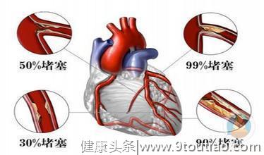 心脏三根动脉，其中一根堵百分之六十了，可以确诊为冠心病吗？