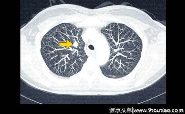 肺癌危险因素多，过了40岁，一定按期检查CT，4类人更高危！