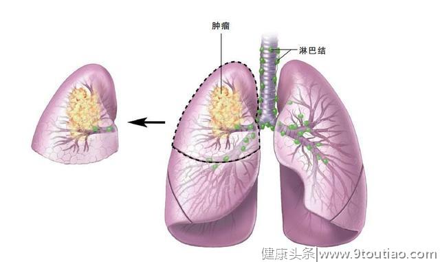 "肺癌"确诊前，身体会出现5种现象，别视若无睹，尽早查CT