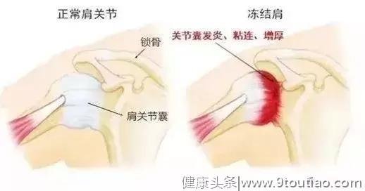 不是所有肩痛都是“肩周炎”