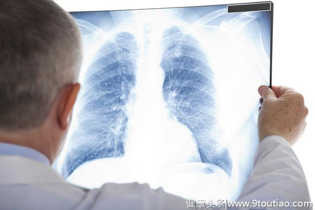 谁说肺癌一定是老烟民？忽视这6个原因，年轻人也会被肺癌盯上