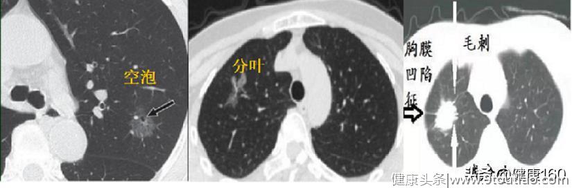 CT报告上写着“肺小结节”，是否是肺癌？协和医学博士告诉你