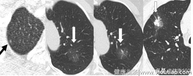 CT报告上写着“肺小结节”，是否是肺癌？协和医学博士告诉你